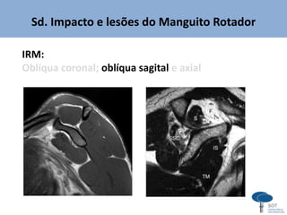 Sd. Impacto e lesões do Manguito Rotador
IRM:
Oblíqua coronal; oblíqua sagital e axial
 