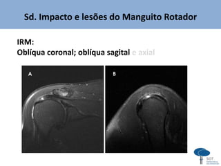 Sd. Impacto e lesões do Manguito Rotador
IRM:
Oblíqua coronal; oblíqua sagital e axial
 