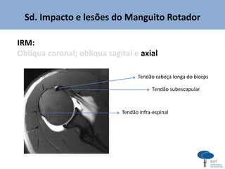 Sd. Impacto e lesões do Manguito Rotador
IRM:
Oblíqua coronal; oblíqua sagital e axial
Tendão subescapular
Tendão infra-espinal
Tendão cabeça longa do bíceps
 
