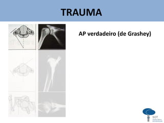 TRAUMA
AP verdadeiro (de Grashey)
v
 