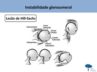 Instabilidade glenoumeral
Lesão de Hill-Sachs
 