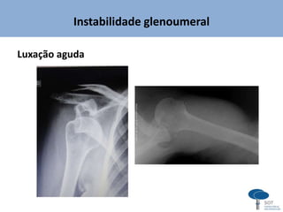 Instabilidade glenoumeral
Luxação aguda
 