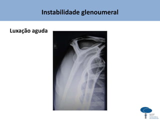 Instabilidade glenoumeral
Luxação aguda
 