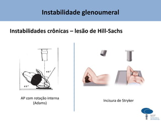 Instabilidade glenoumeral
Instabilidades crônicas – lesão de Hill-Sachs
Incisura de Stryker
AP com rotação interna
(Adams)
 