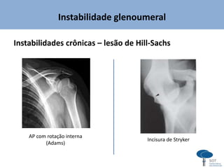 Instabilidade glenoumeral
Instabilidades crônicas – lesão de Hill-Sachs
Incisura de Stryker
AP com rotação interna
(Adams)
 