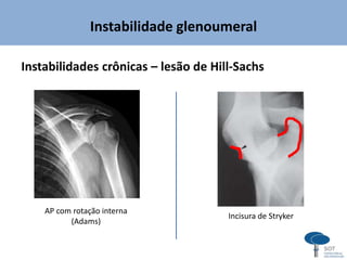 Instabilidade glenoumeral
Instabilidades crônicas – lesão de Hill-Sachs
Incisura de Stryker
AP com rotação interna
(Adams)
 