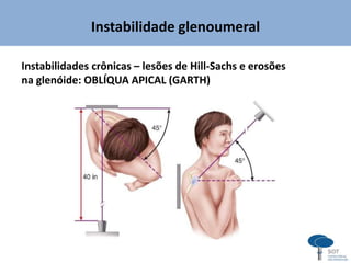 Instabilidade glenoumeral
Instabilidades crônicas – lesões de Hill-Sachs e erosões
na glenóide: OBLÍQUA APICAL (GARTH)
 