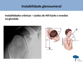 Instabilidade glenoumeral
Instabilidades crônicas – Lesões de Hill-Sachs e erosões
na glenóide
 