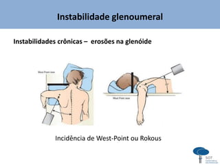 Instabilidade glenoumeral
Instabilidades crônicas – erosões na glenóide
Incidência de West-Point ou Rokous
 