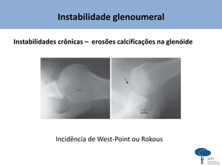 Instabilidade glenoumeral
Instabilidades crônicas – erosões calcificações na glenóide
Incidência de West-Point ou Rokous
 