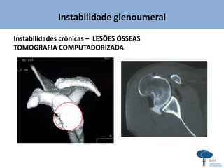 Instabilidade glenoumeral
Instabilidades crônicas – LESÕES ÓSSEAS
TOMOGRAFIA COMPUTADORIZADA
 