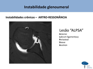 Instabilidade glenoumeral
Instabilidades crônicas – ARTRO-RESSONÂNCIA
Lesão “ALPSA”
Anterior
Labrum-ligamentous
Periosteal
Sleeve
Avulsion
 