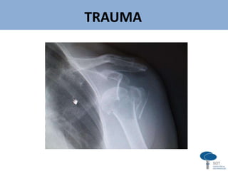 TRAUMA
v
 