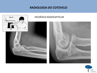 RADIOLOGIA DO COTOVELO
INCIDÊNCIA RADIOCAPITELAR
 