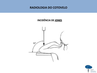RADIOLOGIA DO COTOVELO
INCIDÊNCIA DE JONES
 