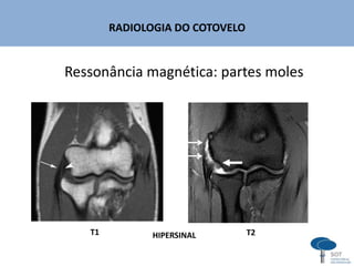 RADIOLOGIA DO COTOVELO
Ressonância magnética: partes moles
T2T1 HIPERSINAL
 