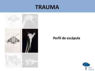 TRAUMA
Perfil de escápula
v
 