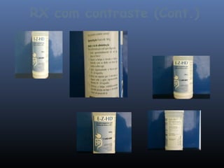 RX com contraste (Cont.)
 