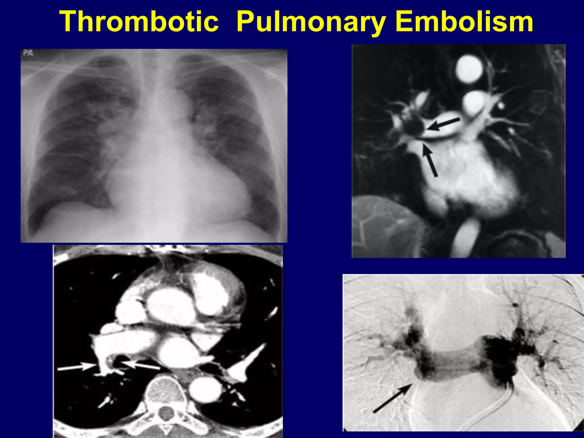 Imaging of Pulmonary Embolism | PDF | Lung and Respiratory Health ...