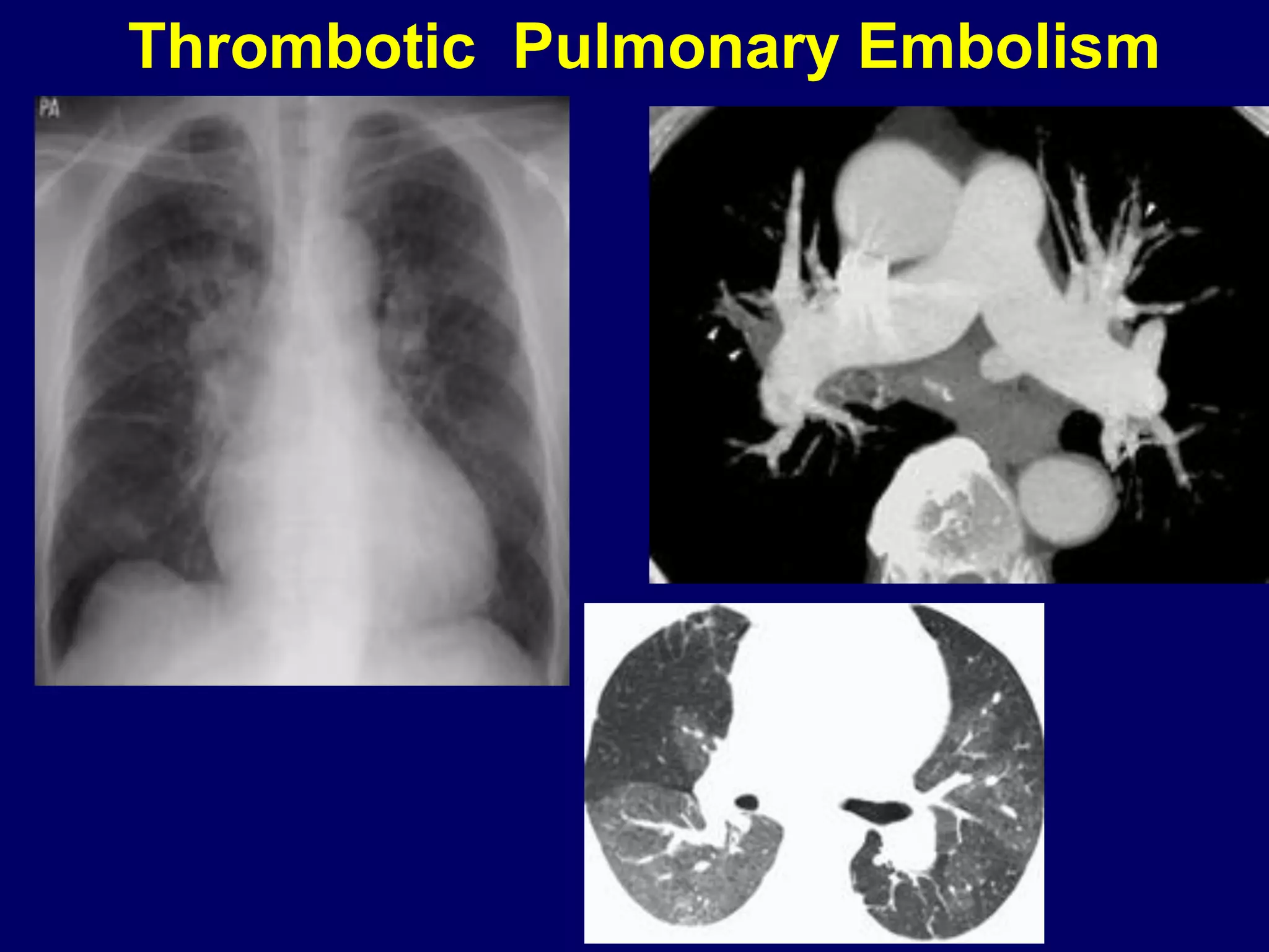 Imaging of Pulmonary Embolism | PDF | Lung and Respiratory Health ...