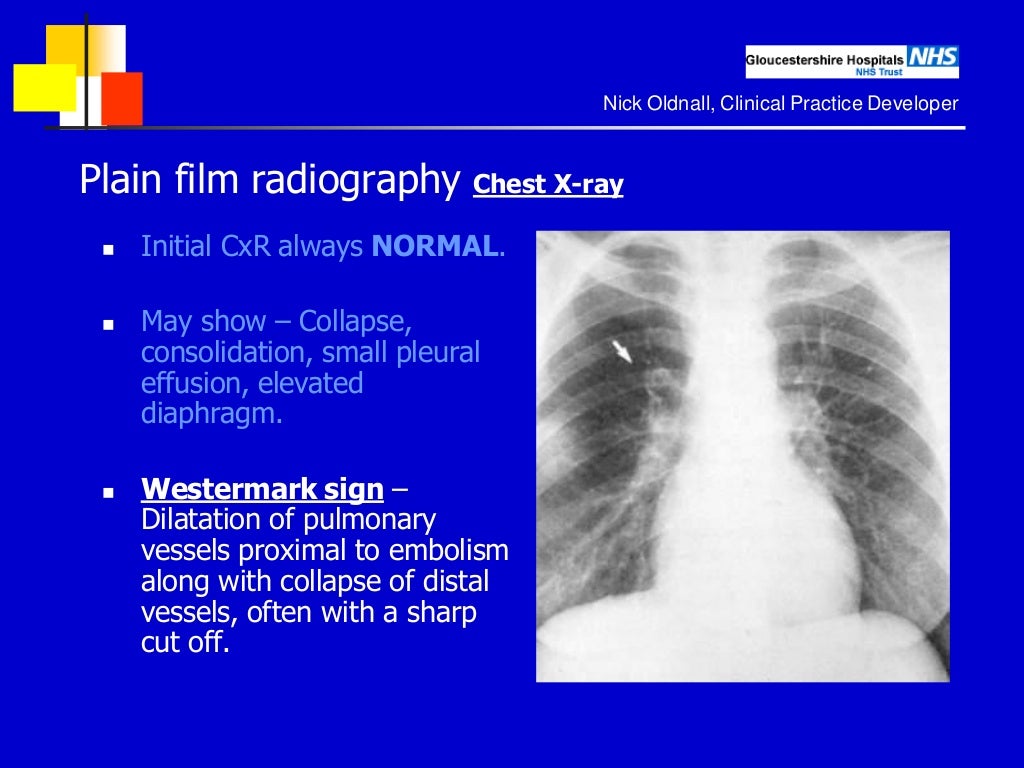 Imaging of Pulmonary Embolism