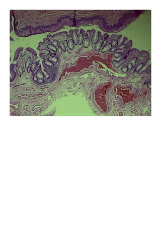 Imágenes patología practica hemorroides