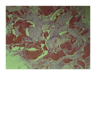Imágenes patología practica hemorroides