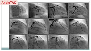 AngioTAC
 