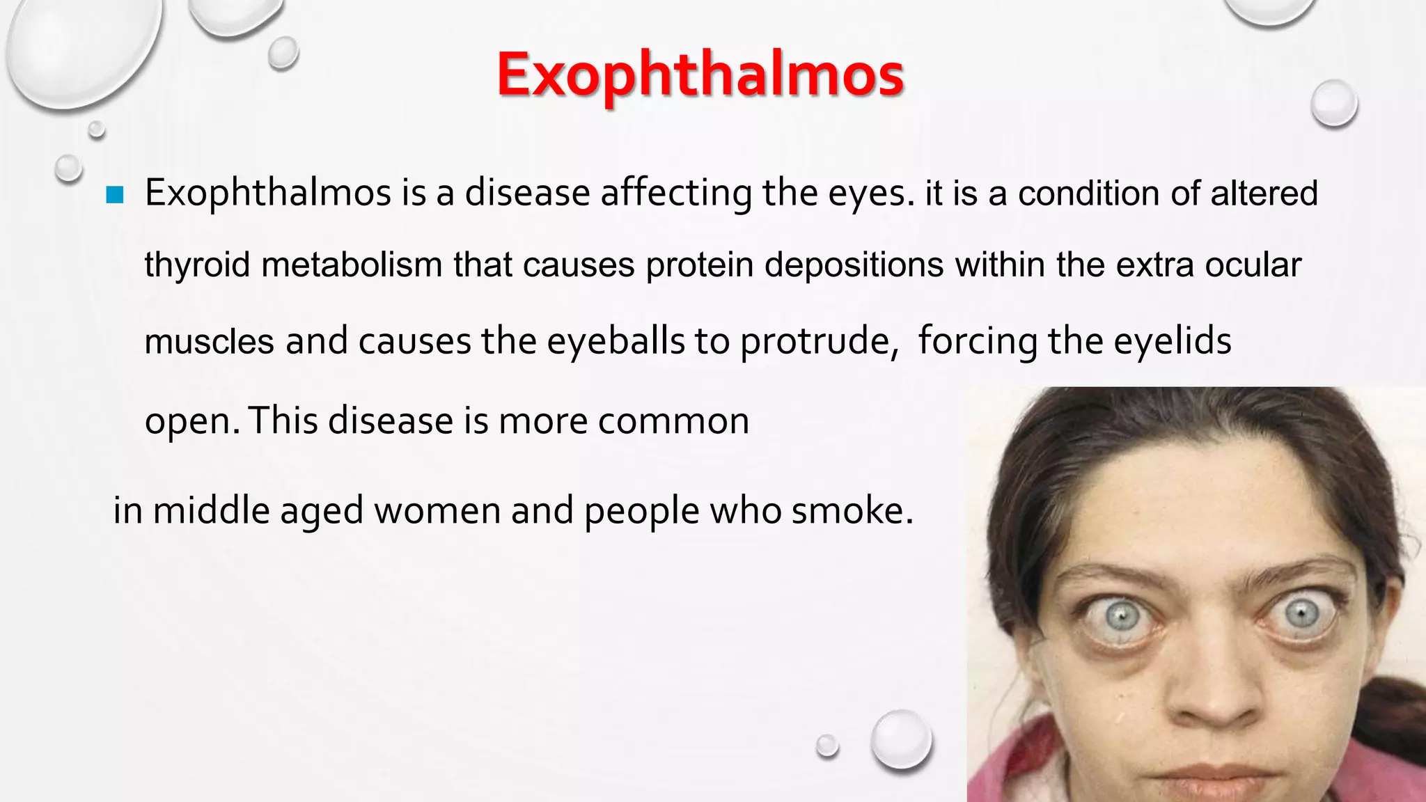 Exophthalmos
 Exophthalmos is a disease affecting the eyes. it is a condition of altered
thyroid metabolism that causes protein depositions within the extra ocular
muscles and causes the eyeballs to protrude, forcing the eyelids
open.This disease is more common
in middle aged women and people who smoke.
 