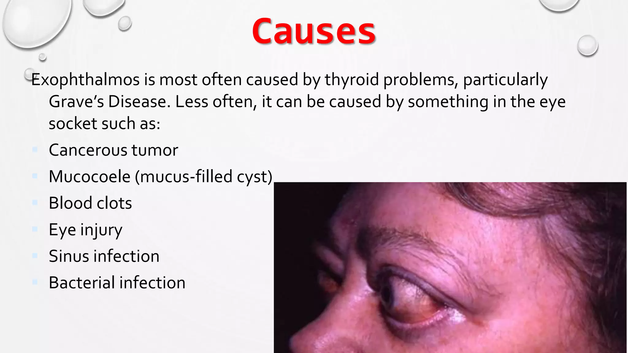 Causes
Exophthalmos is most often caused by thyroid problems, particularly
Grave’s Disease. Less often, it can be caused by something in the eye
socket such as:
 Cancerous tumor
 Mucocoele (mucus-filled cyst)
 Blood clots
 Eye injury
 Sinus infection
 Bacterial infection
 