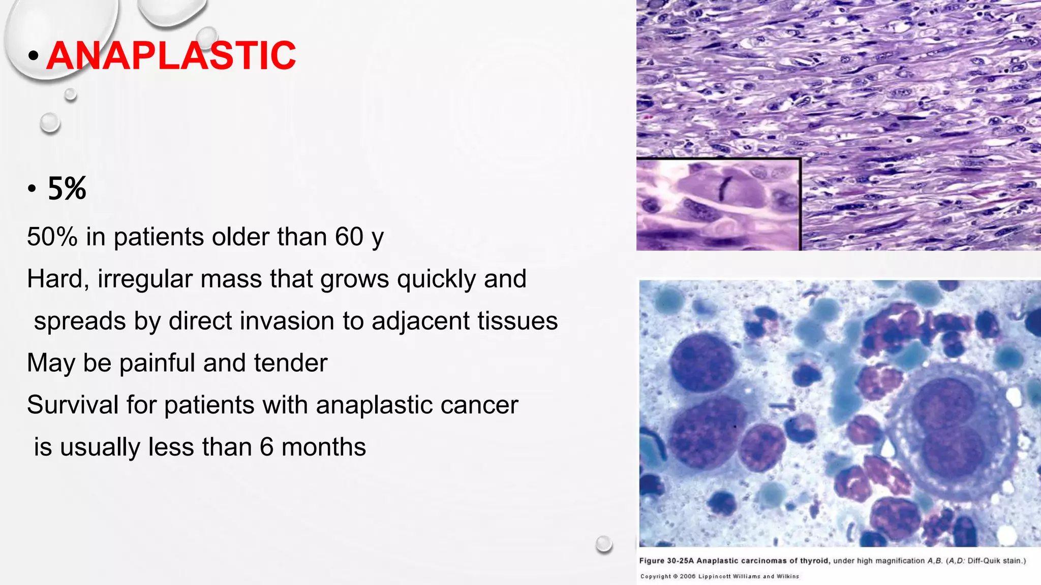 • ANAPLASTIC
• 5%
50% in patients older than 60 y
Hard, irregular mass that grows quickly and
spreads by direct invasion to adjacent tissues
May be painful and tender
Survival for patients with anaplastic cancer
is usually less than 6 months
 