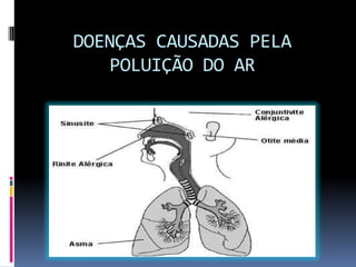 DOENÇAS CAUSADAS PELA
POLUIÇÃO DO AR
 