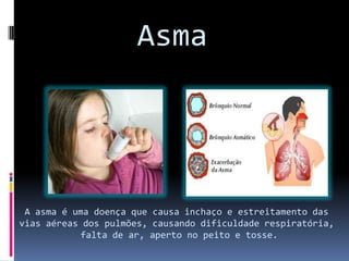 Asma
A asma é uma doença que causa inchaço e estreitamento das
vias aéreas dos pulmões, causando dificuldade respiratória,
falta de ar, aperto no peito e tosse.
 