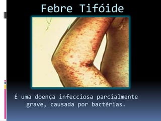 Febre Tifóide
É uma doença infecciosa parcialmente
grave, causada por bactérias.
 