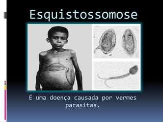 Esquistossomose
É uma doença causada por vermes
parasitas.
 