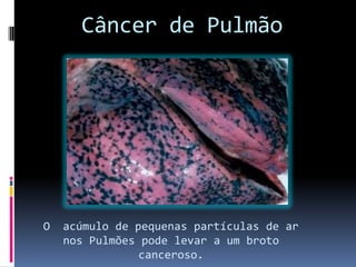 Câncer de Pulmão
O acúmulo de pequenas partículas de ar
nos Pulmões pode levar a um broto
canceroso.
 