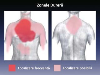 Zonele Durerii
Localizare frecventă Localizare posibilă
 