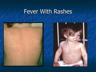 Fever With Rashes
 