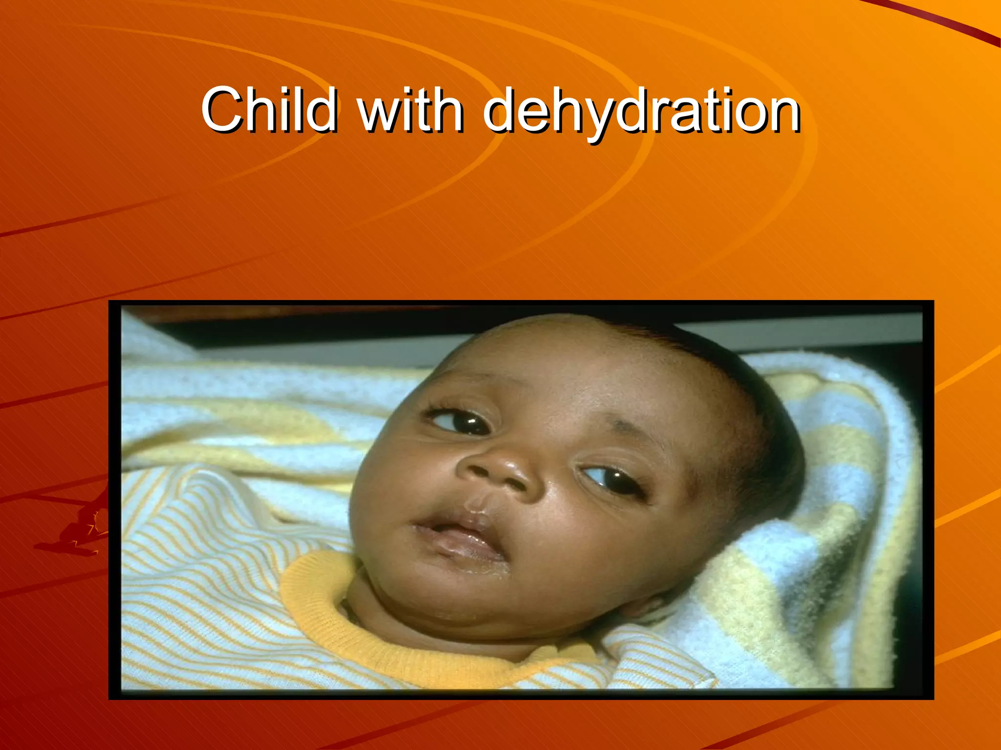 Child with dehydration 