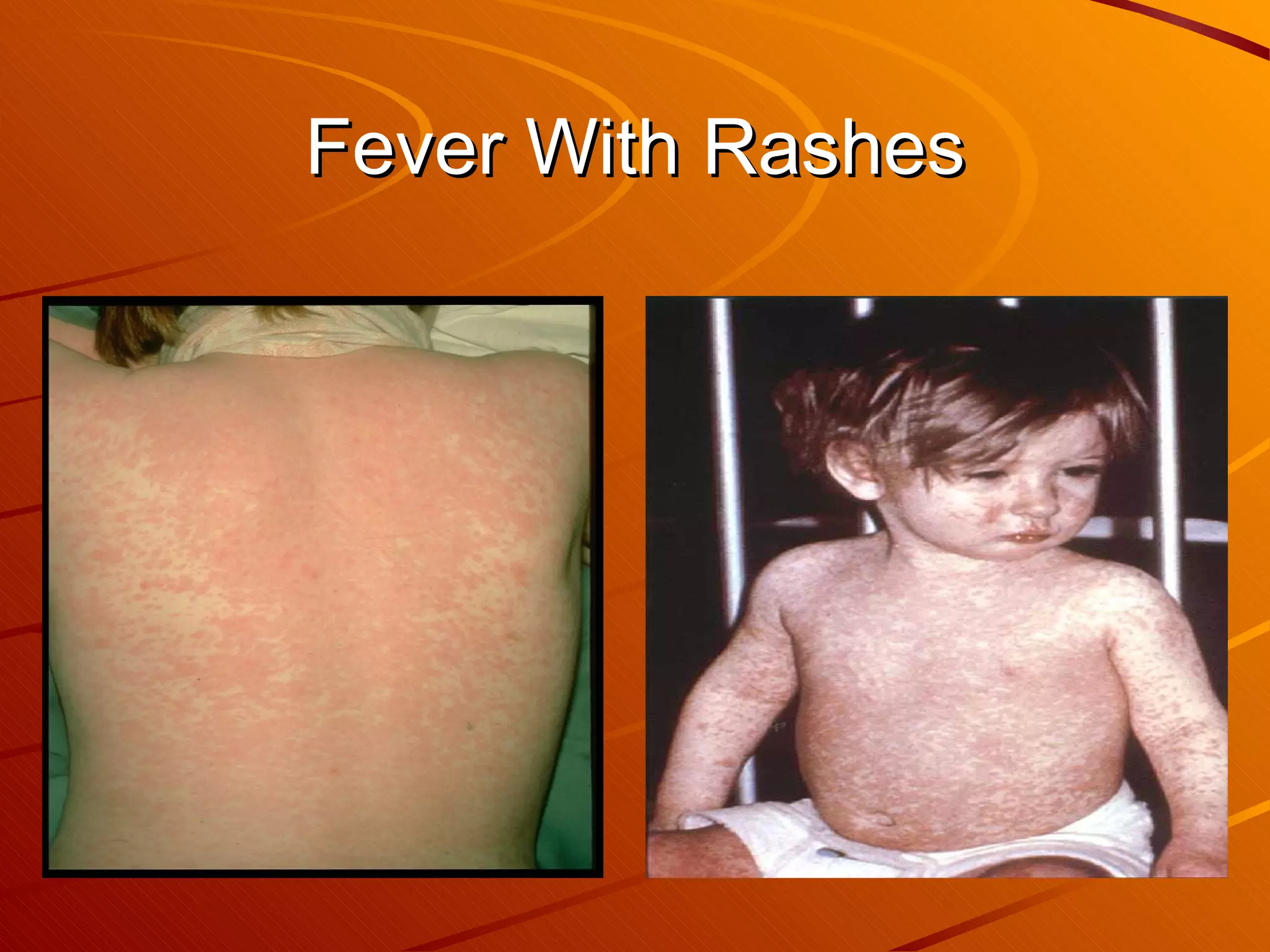 Fever With Rashes 