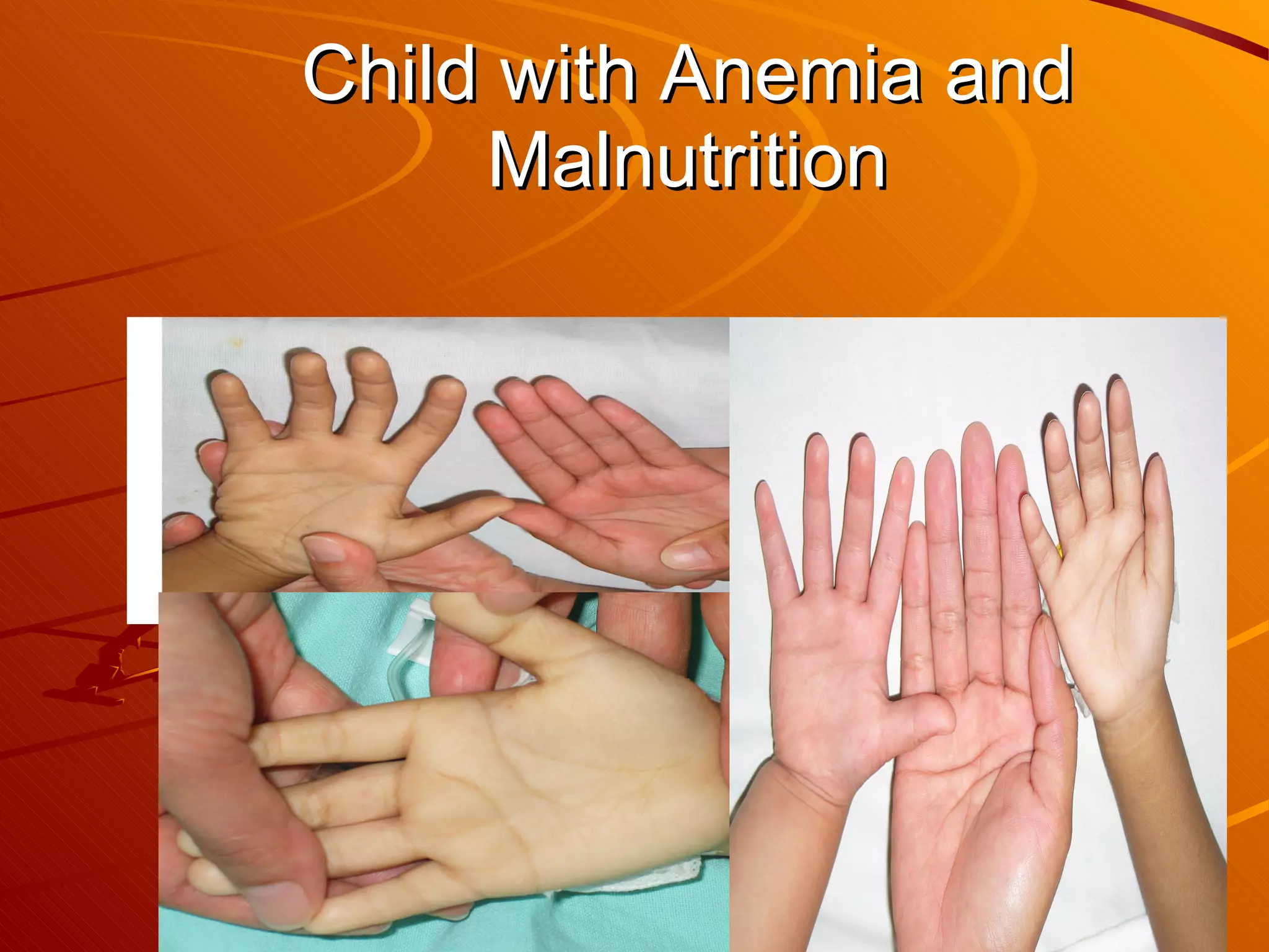Child with Anemia and Malnutrition 