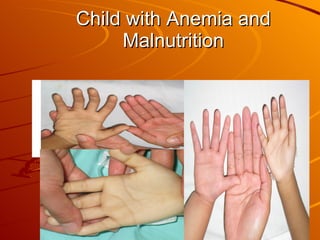 Child with Anemia and Malnutrition 