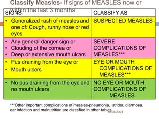 Classify Measles- If signs of MEASLES now or
within the last 3 months
10/04/2024
66
***Other important complications of measles-pneumonia, stridor, diarrhoea,
ear infection and malnutrition are classified in other tables
SIGNS CLASSIFY AS
• Generalized rash of measles and
one of: Cough, runny nose or red
eyes
SUSPECTED MEASLES
• Any general danger sign or
• Clouding of the cornea or
• Deep or extensive mouth ulcers
SEVERE
COMPLICATIONS OF
MEASLES***
• Pus draining from the eye or
• Mouth ulcers
EYE OR MOUTH
COMPLICATIONS OF
MEASLES***
• No pus draining from the eye and
no mouth ulcers
NO EYE OR MOUTH
COMPLICATIONS OF
MEASLES
 