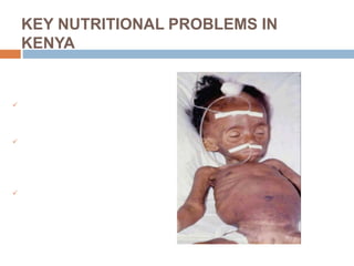 KEY NUTRITIONAL PROBLEMS IN
KENYA
 Growth Faltering
 Micronutrient deficiencies
(Iodine, Iron, Vitamin A)
 Sub-optimal Breastfeeding
 