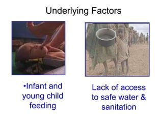 •Infant and
young child
feeding
Lack of access
to safe water &
sanitation
Underlying Factors
 
