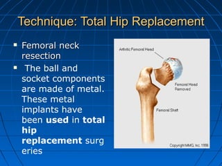 Technique: Total Hip ReplacementTechnique: Total Hip Replacement
 Femoral neckFemoral neck
resectionresection
 The ball and
socket components
are made of metal.
These metal
implants have
been used in total
hip
replacement surg
eries
 