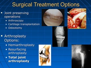 Surgical Treatment OptionsSurgical Treatment Options
 Joint preservingJoint preserving
operationsoperations
• ArthroscopyArthroscopy
• Cartilage transplantationCartilage transplantation
• OsteotomyOsteotomy
 ArthroplastyArthroplasty
Options:Options:
• HemiarthroplastyHemiarthroplasty
• ResurfacingResurfacing
arthroplastyarthroplasty
• Total jointTotal joint
arthroplastyarthroplasty
 