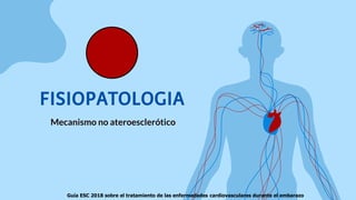FISIOPATOLOGIA
Mecanismo no ateroesclerótico
Guía ESC 2018 sobre el tratamiento de las enfermedades cardiovasculares durante el embarazo
 