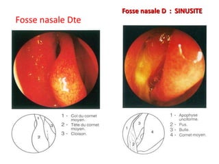 Fosse nasale Dte
Fosse nasale D : SINUSITE
 