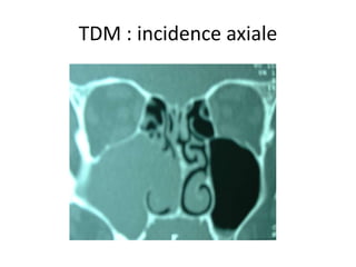 TDM : incidence axiale
 